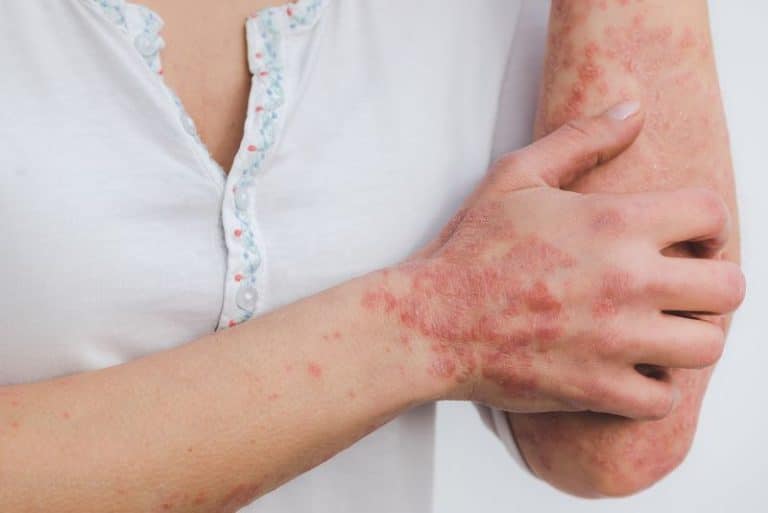 Psoriasis 19